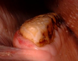 Bit seating on the number 6 pre-molar